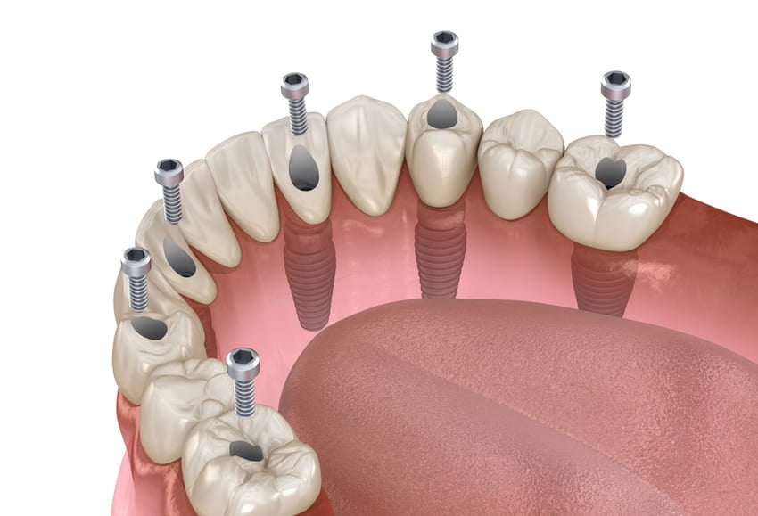 Implant All-on-6