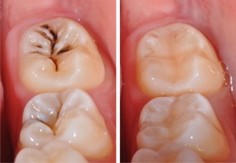 Trám Bít Hố Rãnh