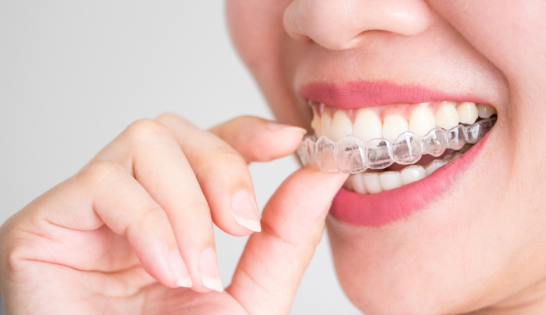 Răng chen chúc, sai khớp cắn hoặc Invisalign